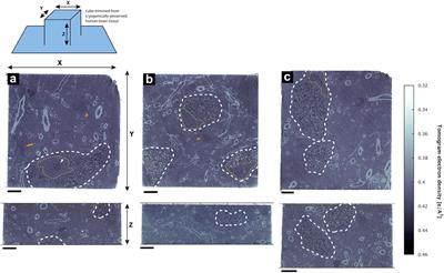 Alterations in Sub-Axonal Architecture Between Normal Aging and Parkinson’s Diseased Human Brains Using Label-Free Cryogenic X-ray Nanotomography